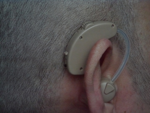 突発性難聴の後遺症と予後