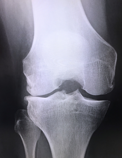 膝変形性関節症の主な治療法