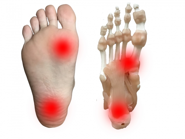 足底筋膜炎の特徴とオステオパシーの役割